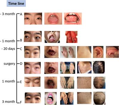 Case Report: A rare pediatric case of paraneoplastic pemphigus associated with Castleman disease misdiagnosed as Behçets disease